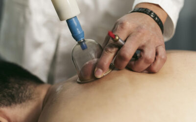 Cupping Therapy: All you need to know